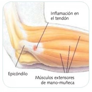 Esquema anatómico de la epicondilitis